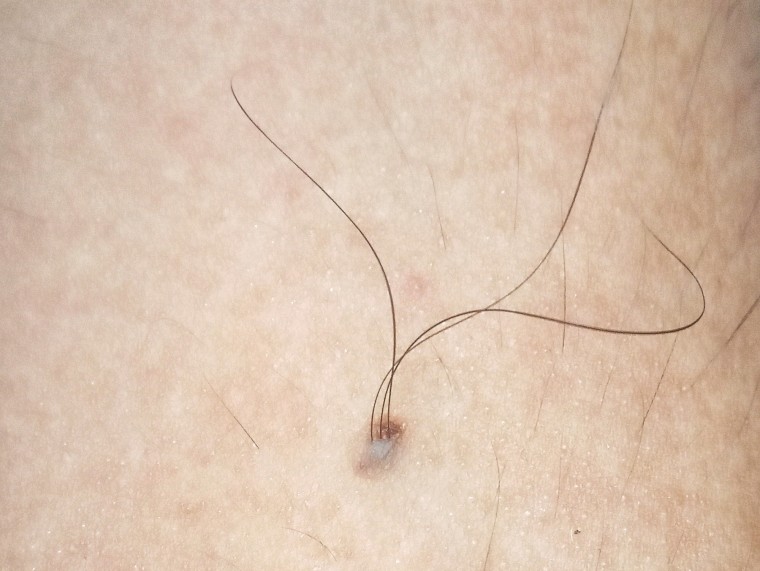 Skin moles that grow hair may offer a treatment for baldness, a study in mice suggests