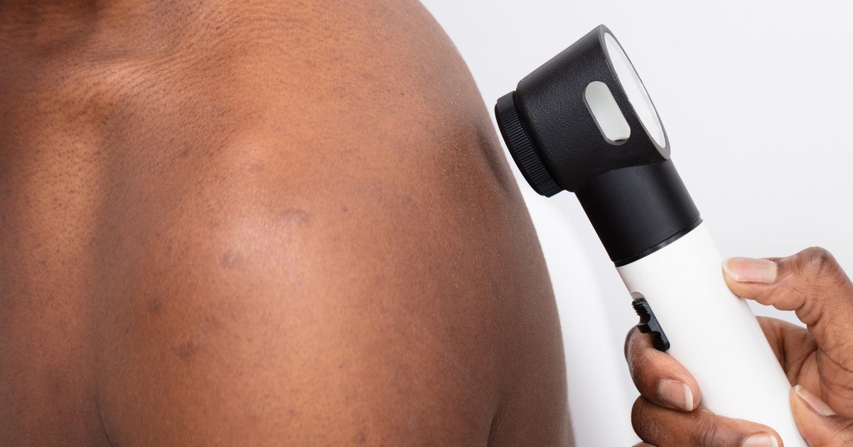 Black men are at an increased risk for melanoma, study finds