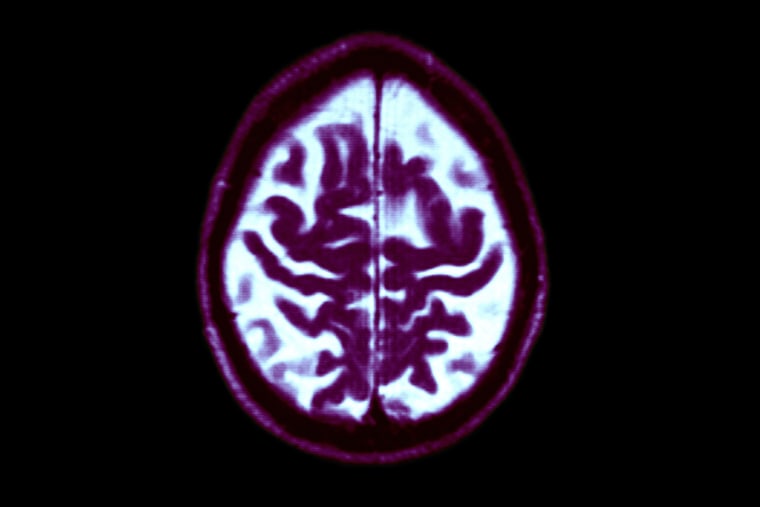 Alzheimer Disease, Mri