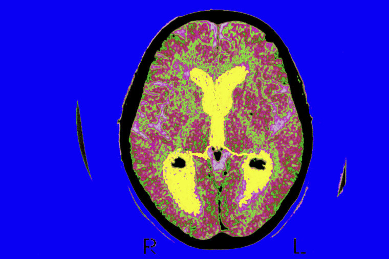 FDA grants full approval to new Alzheimer’s drug meant to slow disease