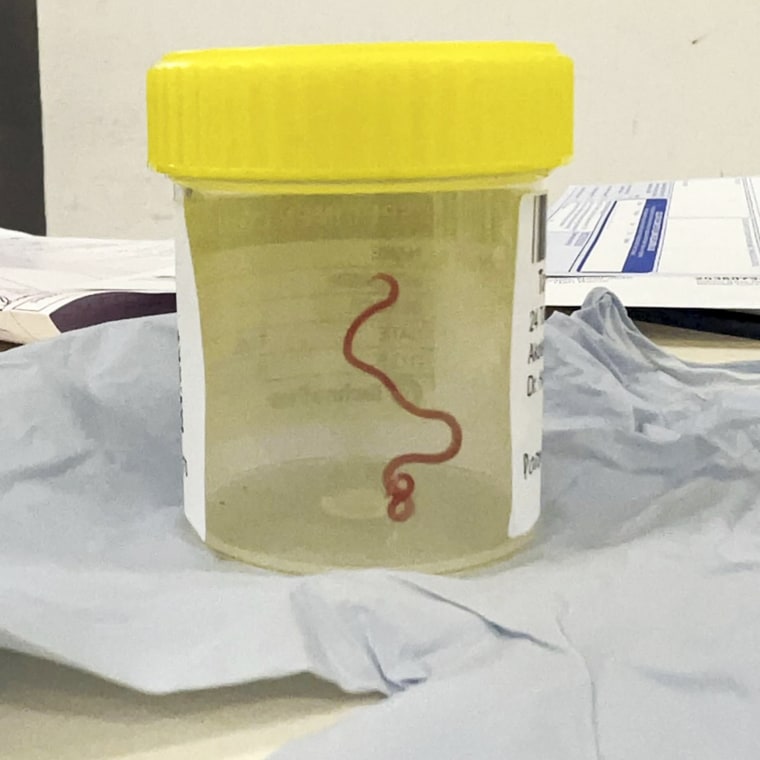 Live worm plucked from woman’s brain in Australia in a world first