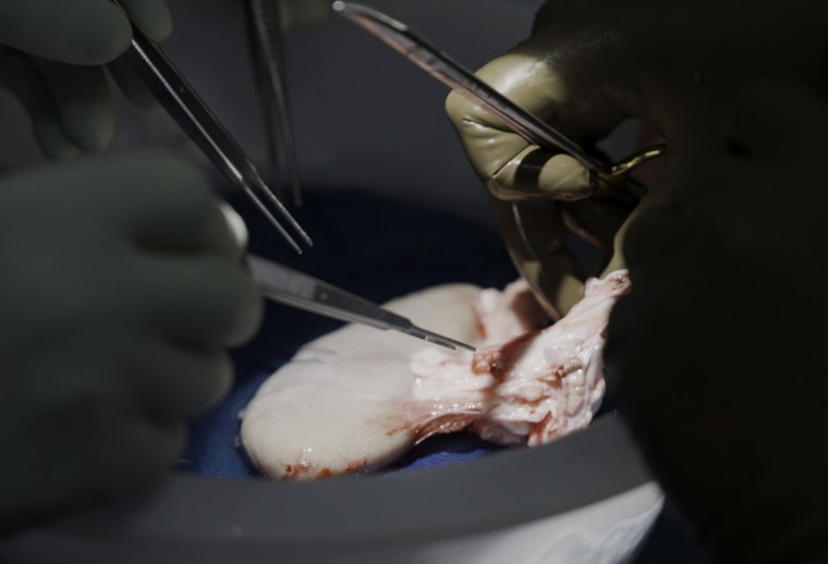 Pig kidney works in a brain-dead man for over a month, a step toward animal-human transplants