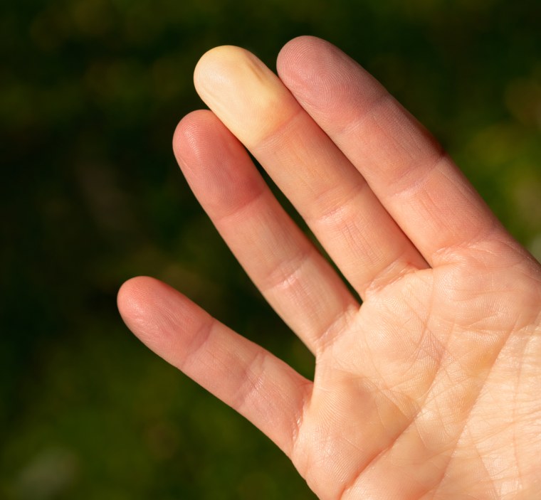 Largest ever genetic study of Raynaud’s phenomenon could lead to new treatments