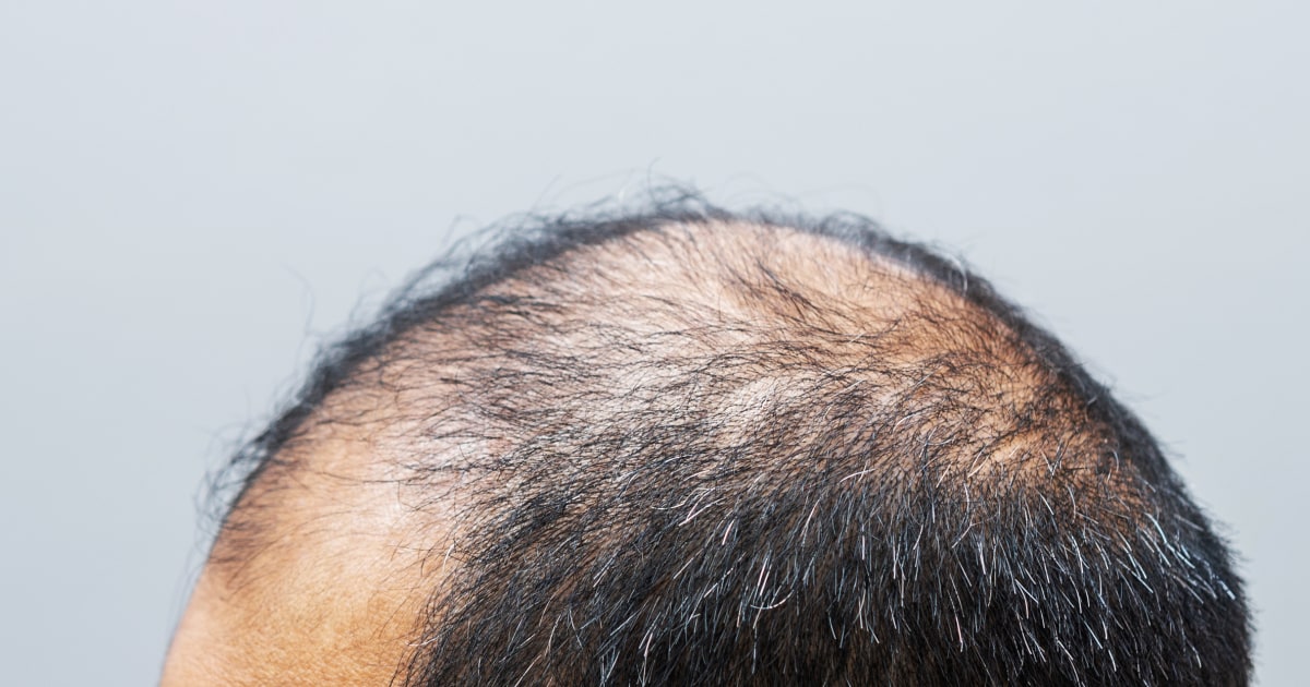 Shortage of drug that treats thinning hair is a ‘significant problem,’ doctors say