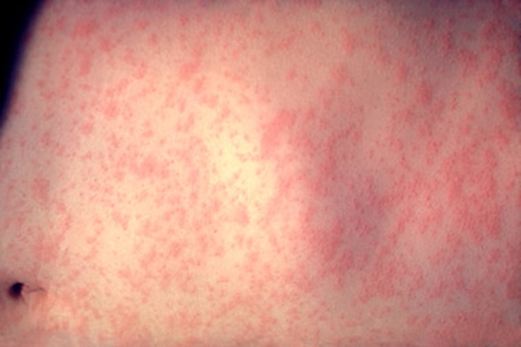 Philadelphia measles outbreak has hospitals on alert after infected child attends day care