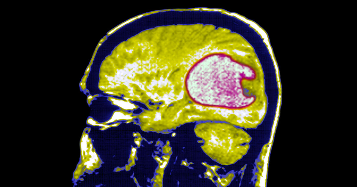 In two early trials, blood cancer treatment appears promising for deadly brain tumor