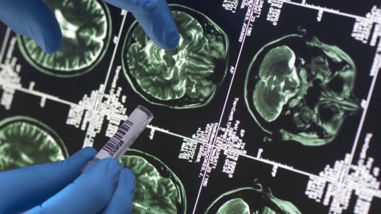 Research shows new blood tests could detect Alzheimer’s disease more accurately